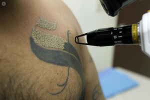 absorcion de luz eliminacion tatuajes laser